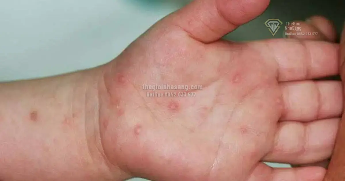 Tác Động Của Dịch Bệnh Tay Chân Miệng Đến Thị Trường Bất Động Sản Và Quy Hoạch Đô Thị Năm 2026