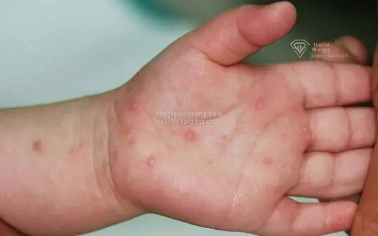 Tác Động Của Dịch Bệnh Tay Chân Miệng Đến Thị Trường Bất Động Sản Và Quy Hoạch Đô Thị Năm 2026